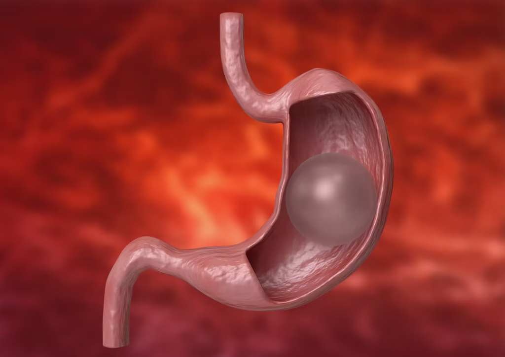 Gastric Balloon Istanbul – Gastric Balloon Turkey – Non Surgical Weight Loss Turkey – Gastric Balloon Clinic Turkey – Gastric Balloon Cost Turkey