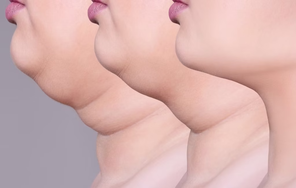 Best Clinic for Chin Liposuction – Double Chin Liposuction Turkey – Chin Liposuction Istanbul – Affordable Liposuction Turkey – Double Chin Treatment Turkey