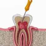 ЛЕЧЕНИЕ КАНАЛА КОРНЯ
